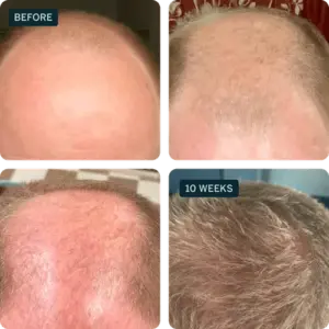 Happy Head hair result